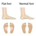 Hollow, flat, and normal foot. Foot deformity types, medical disease infographics.